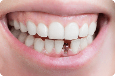 Имплантация зубов от А до Я